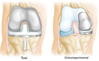 afi hip & knee replacement in noida