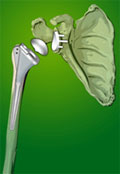 afi joint replacement best knee replacement surgeon in noida