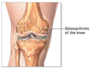 afi joint replacement best arthritis specialist in noida