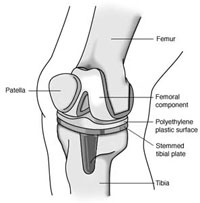 afi joint replacement joint replacement in noida
