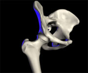 afi joint replacement joint replacement in noida