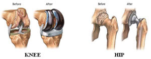 afi joint replacement knee replacement surgeon in noida